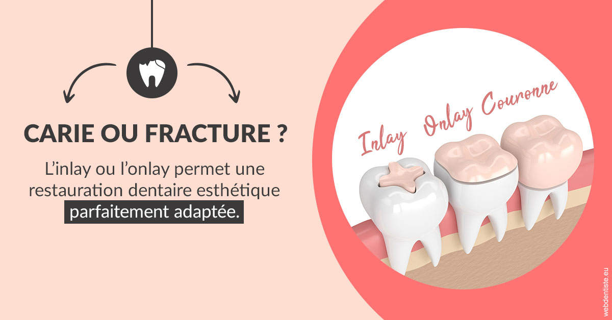 https://selarl-edanael.chirurgiens-dentistes.fr/T2 2023 - Carie ou fracture 2