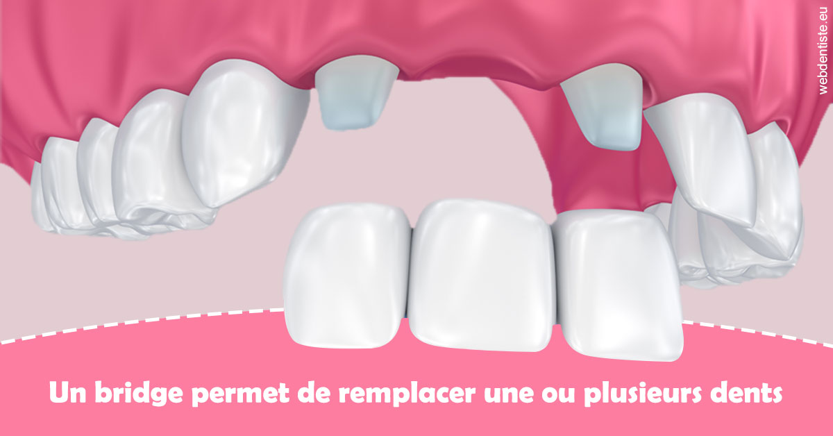 https://selarl-edanael.chirurgiens-dentistes.fr/Bridge remplacer dents 2