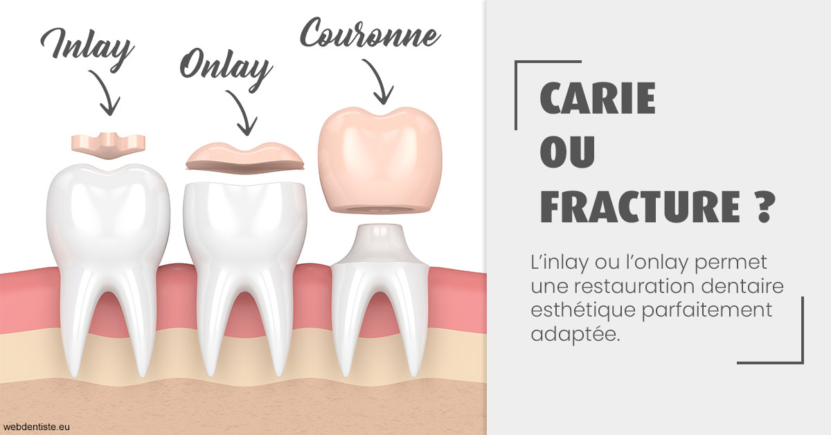 https://selarl-edanael.chirurgiens-dentistes.fr/T2 2023 - Carie ou fracture 1