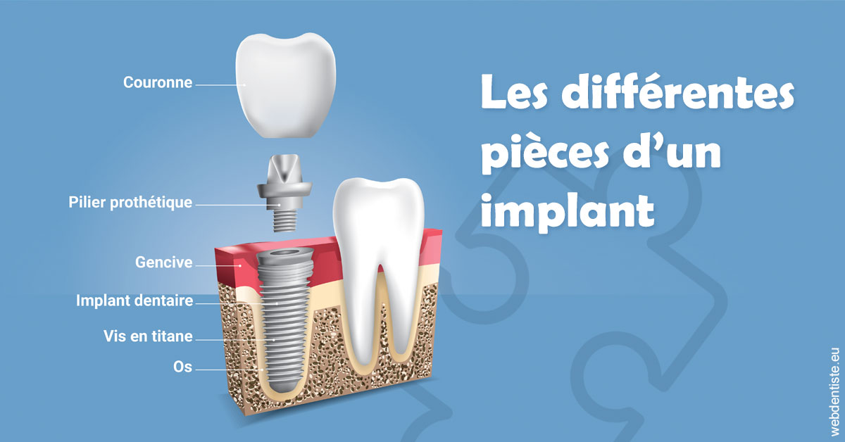 https://selarl-edanael.chirurgiens-dentistes.fr/Les différentes pièces d’un implant 1